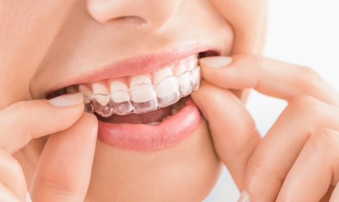 Şeffaf Plak Tedavisi Nedir, Kimlere Uygulanır?
