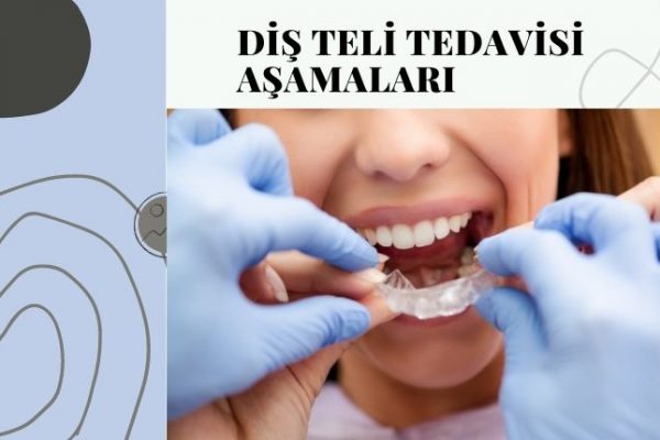 Diş Teli Tedavisi Aşamaları