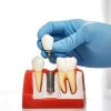Sorularla Dental İmplant Hakkında Merak Ettikleriniz