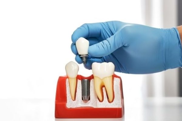 Sorularla Dental İmplant Hakkında Merak Ettikleriniz