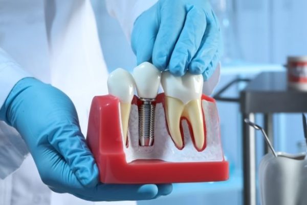 İmplant Sonrası Bakım ve Öneriler